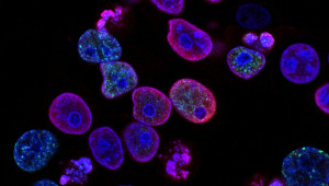 Αντικαταθλιπτικό φάρμακο δίνει ελπίδα για τη θεραπεία επιθετικού καρκίνου στον εγκέφαλο