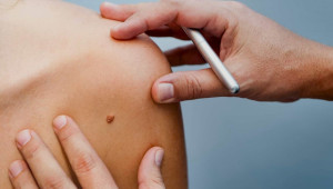 Διεθνής έρευνα αποκαλύπτει: Σχεδόν 4 στους 10 καρκίνους παγκοσμίως θα μπορούσαν να είχαν προληφθεί