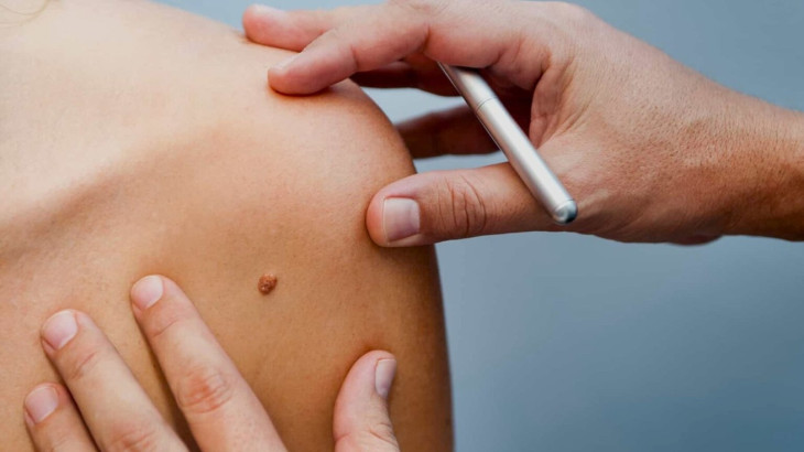 Διεθνής έρευνα αποκαλύπτει: Σχεδόν 4 στους 10 καρκίνους παγκοσμίως θα μπορούσαν να είχαν προληφθεί