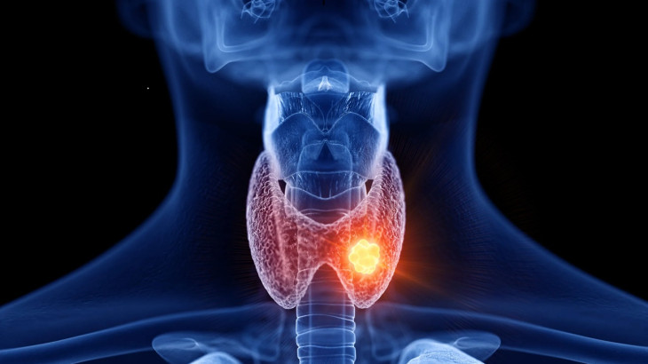 Τετραπλάσιος από τον Ευρωπαϊκό ο μ.ο. καρκίνου θυρεοειδούς στην Κύπρο